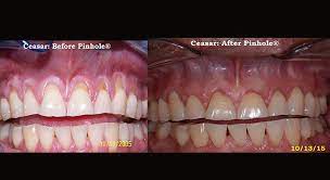 How to stop receding gums getting worse teeth.#recedinggums. Signs Of Gum Recession And What To Do About It Family And Cosmetic Dentist In Commerce Twp Mi