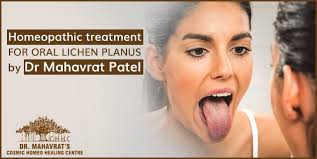 Homeopathic Treatment For Oral Lichen Planus By Dr Mahavrat Patel