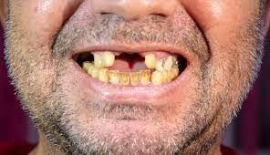 Dental implants are not even covered in most dental insurance plans since it generally falls under cosmetic surgery, a secondary and usually luxurious need compared to the basic and restorative dental procedures much needed by majority of americans. Can Oral Care Help Recovering Drug Addicts Dr Suffoletta Dentistry