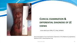 Image result for Edema Exam