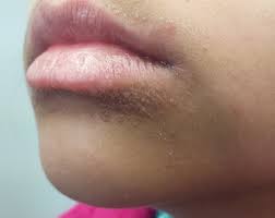 Having pimples around your mouth implies the following the appearance of small red pimples around mouth skin could also be herpes labials. Young Patient With Bumps Near Her Mouth Clinician Reviews