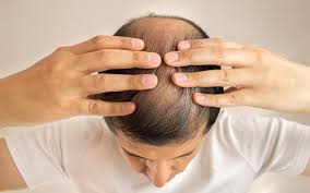 The hair grows back within 12 months or less. Hair Loss 7 Types And Ayurvedic Ways To Cure It Vedix