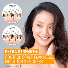 Amazon.com: Neutrogena Scalp Therapy Champú anticaspa extra fuerte, con 3%  de ácido salicílico, sin fragancia, 12 fl oz : Belleza y Cuidado Personal