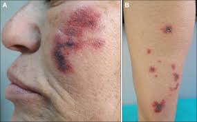 (lond), university of texas health science center, san antonio, texas. Retiform Purpura Caused By The Use Of Cocaine That Was Probably Adulterated With Levamisole Abstract Europe Pmc