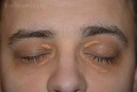 Image result for xantelasma