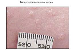 Появление атеромы, отчего это происходит? Zlokachestvennye Obrazovaniya Na Kozhe Novoobrazovaniya Na Kozhe Foto I Opisanie Na Golove Rukah Lice I Tele