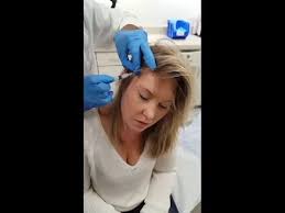 Steroid injections do not cause any hair loss or permanent hair loss. Alopecia Steroid Injections Youtube