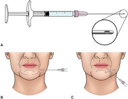 This post may contain affiliate links. Injection Technique In Neurotoxins And Fillers Indications Products And Outcomes Journal Of The American Academy Of Dermatology