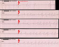Image result for Ventricular Fibrillation