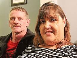 Girl's scars elicit screams from classmates