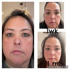 I have been strict fs for a number of years and have been using Sukin Rose  hip oil