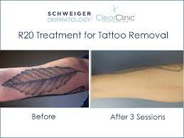 Juvessentials permanent makeup 3458 18th street san francisco, ca 94110. R20 Laser Tattoo Removal Technique Youtube