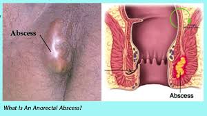 Image result for Intersphincteric Abscess