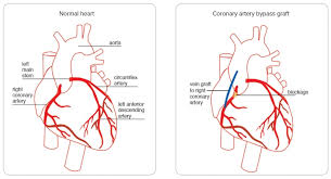Although the heart is full of blood, the blood in the chambers of the heart is not used to oxygenate the muscles of the heart. Coronary Artery Bypass Graft Surgery Heart Foundation