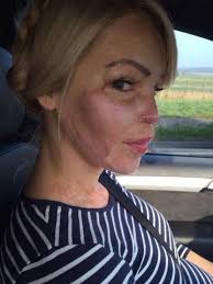 Straciła twarz, ale nie szansę na miłość