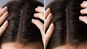 How to Get Rid of Dandruff and Hair Fall ? | Mamaearth