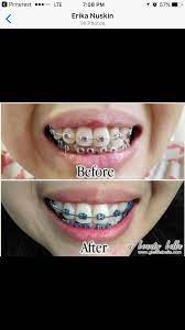 Pin On Whitening Toothpaste Ap24