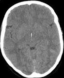 Image result for icd 10 code for brain swelling