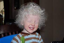 Beautiful Albinism On Pinterest Albinism Albino Model And Albinizm Fotograf Bebek