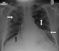 There are many possible causes of . Asbestos Related Pleural Plaques Significance And Associations Bmj Case Reports