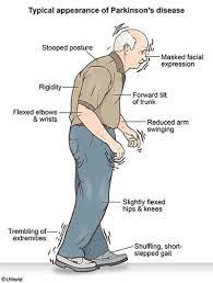 Confirmation That Acupuncture Provides Relief For Parkinson S Disease Lucy Postolov