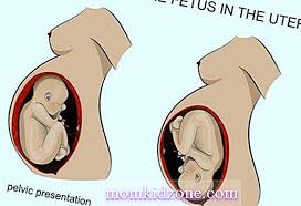 Bayi dalam kandungan songsang atau breech memang boleh menimbulkan keresahan di kalangan ibu. Posisi Bayi Berbeda Dalam Kandungan Kehamilan 2021
