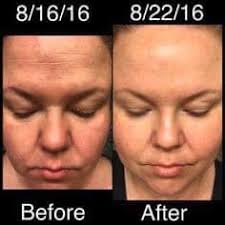 I have been using Sotoks and one drop wonder for 2 months twice daily, my  skin is softer, fine lines and wrinkles are diminishing. Age spots are  diminishing! I am so glad