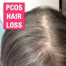 The woman's body also produced testosterone that was in the male body. The Cause Of Pcos Hair Loss Drew Baird Fitness