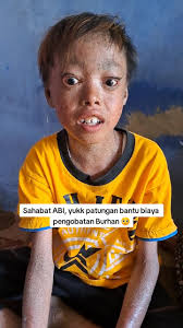 Sahabat ABI, yukk bantu biaya pengobatan Burhan 🥺 Untuk donasi kirim ke  rekening yg ada di BIO #opendonasi #kelainankulit #yayasanasihbumiinsani  #fyp #fypシ #fypシ゚viral #fypage #foryoupage #foryourpage ...