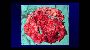 Skip to content search menu this is cancer.net's guide to mesothelioma. The Role Of Decortication In Mesothelioma Ctsnet