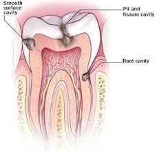 In fact, flossing is one of the top ways to keep your gums healthy, which in return helps prevent cavities from. Smooth Surface Cavities My Dentist Burbank