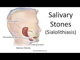 Image result for Sialolithiasis