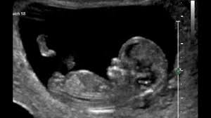Schweißnasse hände, herzklopfen und 'schmetterlinge im bauch'. 11 Schwangerschaftswoche 11 Ssw Alle Infos Eltern De