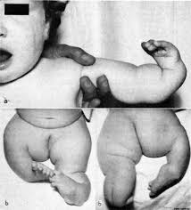Image result for Thalidomide