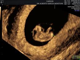 Cardoreco Ecografia Transvaginal 8 Semanas Facebook