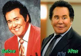 Includes vision brow lift, several botox treatments , blepharoplasty and numerous facelift. Wayne Newton Plastic Surgery Before And After Plastic Surgery Mistakes
