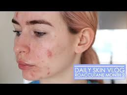 Roaccutane Daily Skin Vlog