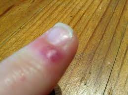 And the symptoms may look like any other type of insect bite. I Think This Is A Spider Bite On My Finger It Showed Up Later In The Day Picture Of Club Hotel Mestre Tripadvisor