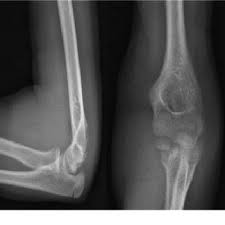 The internal epicondyle —  ˌɛpɪ'kɒndɪl  ■ noun anatomy a protuberance on the condyle of a long bone. Images And Treatment Of Medial Humeral Epicondyle Fracture The Images Download Scientific Diagram