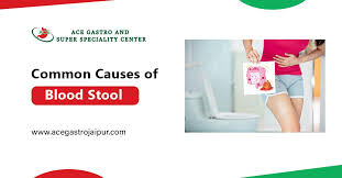 Image result for Blood in stool