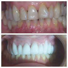 Before And After 11 Emax Restorations Bl2 Bleach Shade Cosmetic Dentistry Dental Dentistry