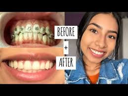 Some musicians are worried about playing musical instruments in which the mouth is involved. Getting My Braces Removed Early Final Update Youtube