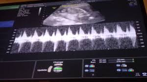 baby boys heartbeat at 16 weeks