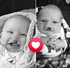 Meet Omar from Somalia! 🇸🇴 Born with a cleft, his journey began with  challenges, but thanks to Smile Train and Kalkaal Hospital, he received the  care he needed early on. “After my