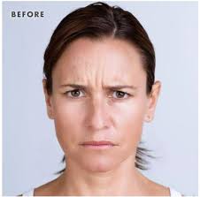 Xeomin Wrinkle Treatments