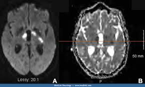 Image result for Cryptococcal Meningitis