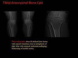 Aneurysmal bone cyst with chromosomal changes involving 7q and 16p. Epos C 1096