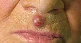 Image result for Merkel Cell Carcinoma