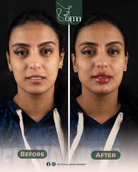 وجهك ينطق بالجمال من جلسة واحدة! #لمى_زهر_الدين #علاج_البشرة #تجميل_الوجه  #عيادة_تجميل #drlomazaheraldeen #NonSurgicalBeauty #NonSurgicalTreatments  #AestheticClinic #SkinCare #BeautyClinic #FacialAesthetics #NaturalBeauty  #DoubleChinTreatment ...