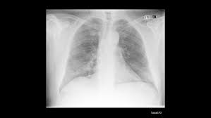 There are also important structures that are obscured or become visible. X Ray Imaging For Covid 19 Patients